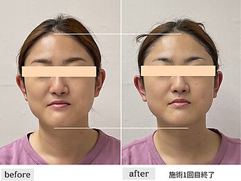 ペルク(perk)/小顔コルギ70分