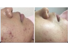 ルナート(Lunart)/ハーブピーリング【お顔】