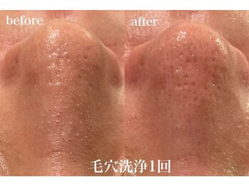 エンソワー(en'sower)/ハイドロスプラッシュで毛穴洗浄