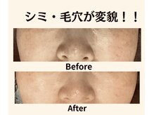 グレースティー 森町 箕面/シミも毛穴も変貌！！★★★