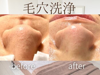 ラグレ(LUXRE)/ハイドロ毛穴洗浄