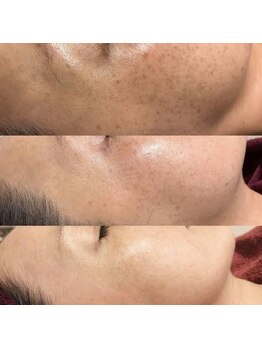 アンジェーム(ANGEAME)/ハーブトリートメント