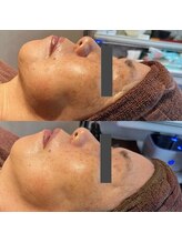 プレイス 天王寺店(PLACE)/ハーブピーリングのお客様です。