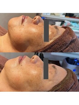 プレイス 天王寺店(PLACE)/ハーブピーリングのお客様です。