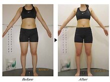 ビューティークリニックコダマ 日向店/【2か月コース】A.K様（21歳）