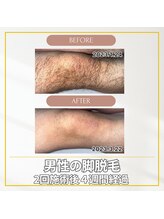 エクレ(EKURE)/男性脚脱毛