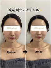 メディカルサロンドオフ 堺東店(medical salon de off)/光造顔フェイシャル★ &nbsp;施術前後