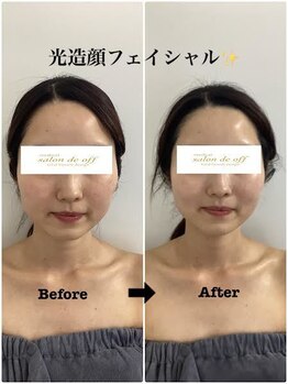 メディカルサロンドオフ 堺東店(medical salon de off)/光造顔フェイシャル★ &nbsp;施術前後