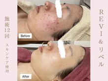 ルア(LuA.)/別人級！肌質改善◎