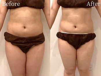 ミスティア(mistia)/エステ 全身3回