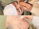 ソル(SOLL)の写真/【セルフケアでは改善されない頑固毛穴！】毛穴の悩みから解放されませんか？憧れの艶肌に◎
