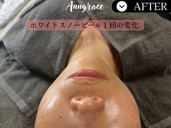 アングレイス(Anngrace)/【本気の肌質改善】圧倒的効果