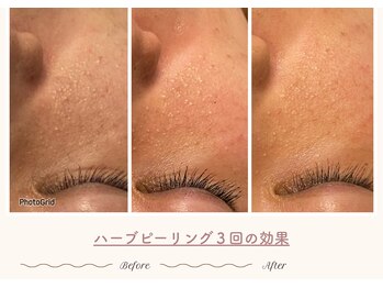 エステティックサロン シーズ/頑固な白いプツプツに◯