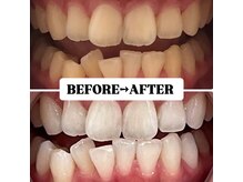 ホワイトニングサロン 豊中/Before&After美白ホワイトニング