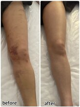 インディバジェム(GEM)/ビフォーアフター