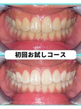 ホワイトニングビューティー 吉祥寺店/ホワイトニング　初来店