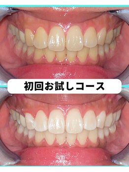 ホワイトニングビューティー 吉祥寺店/ホワイトニング 初来店