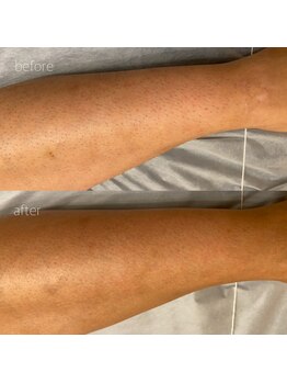 オンセ(once)/足脱毛/全身脱毛