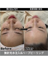 マヴィ 香里園店(MavY.)/ハーブピーリング×水光注入