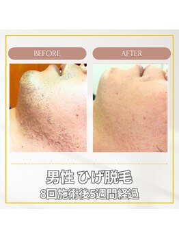 エクレ(EKURE)/男性ヒゲ脱毛