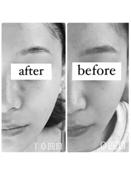 ポエマ(POEMA)/before/after