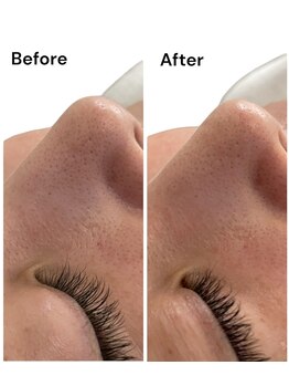 ブライトプラス(BRIGHT+)/ハイドロフェイシャル毛穴洗浄