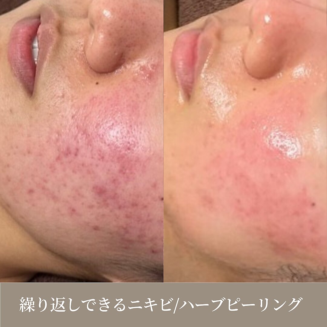 川崎市でピーリングが人気のエステサロン|ホットペッパービューティー 川崎市でピーリングが人気のエステサロン|ホットペッパービューティー