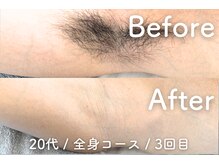 ユング 渋谷店(YUNG)/【脇脱毛】大人のニオイケア脱毛