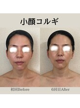 リーブル(LIBRE)/小顔コルギ　6回