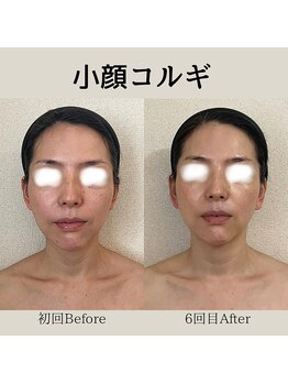 リーブル(LIBRE)/小顔コルギ 6回