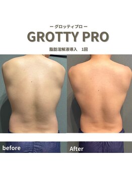 フルアナ(Hu ruana)/痩身/ダイエット/筋膜リリース