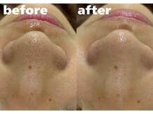 ホワイトラボ 堺東(White labo)/【20代女性 施術5回目の効果】