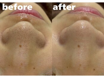 ホワイトラボ 堺東(White labo)/【20代女性 施術5回目の効果】