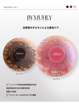 モア(more.)/1回ホルモン変化による着色ケア