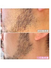 エムスリー(m3)/ヒゲ脱毛