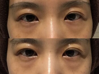 アイリープ(eyeleap)/☆目元徹底クマ・たるみ改善　