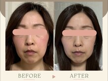 40代・施術5回目　お顔の長さが短く！若見えへ！京都小顔矯正