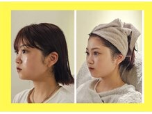 アン 銀座(ann)/レモンボトルで頬をスッキリ