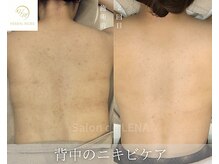 サロン ド レナ(Salon de LENA)/ハーブピーリング サロンドレナ