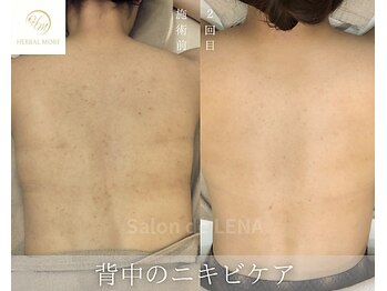 サロン ド レナ(Salon de LENA)/ハーブピーリング サロンドレナ