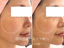 エステティックサロン アールグレー/白玉ホワイトスノーピール1回