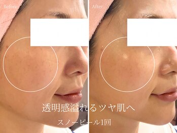 エステティックサロン アールグレー/白玉ホワイトスノーピール1回