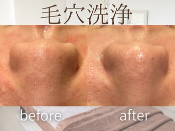 ラグレ(LUXRE)/ハイドロ毛穴洗浄