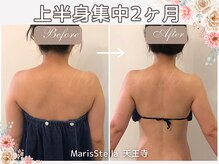 マリスステラ 天王寺(MarisStella)/上半身痩身2ヶ月の変化