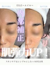 エイル(EILE)/症例2