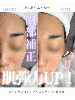 エイル(EILE)/症例2