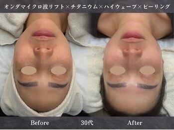 イロハ(IROHA)の写真/次世代最強小顔施術*マイクロ波リフト導入サロン◆二重顎/たるみ/もたつきに!脂肪減少・効果を即実感
