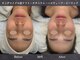 イロハ(IROHA)の写真/次世代最強小顔施術*マイクロ波リフト導入サロン◆二重顎/たるみ/もたつきに!脂肪減少・効果を即実感