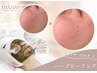 【本気の肌質改善】 クリスティーナ/剥離なしのハーブピーリング¥17600→