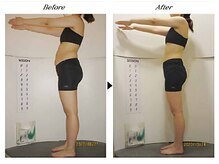 ビューティークリニックコダマ 日向店/【2か月コース】A.K様（21歳）